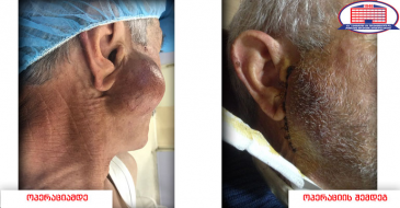 არასდროს დატოვოთ უყურადღებოდ სახეზე წარმონაქმნი – ყბა–სახის ქირურგებმა სანერწყვე ჯირკვლის კეთილთვისებიანი სიმსივნე ამოკვეთეს