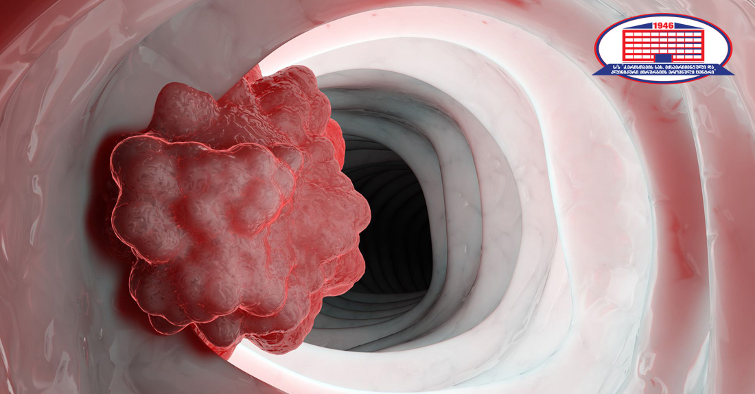 თორმეტგოჯა ნაწლავის ლეიომიოსარკომის მქონე პაციენტის ჯანმრთელობის მდგომარეობა ქირურგიის ეროვნულ ცენტრში ქიმიოთერაპიის კურსით გაუმჯობესდა