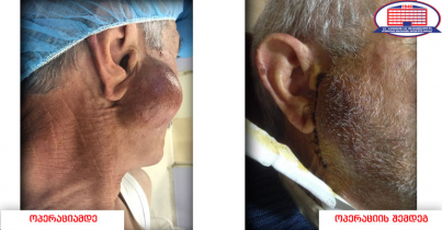 არასდროს დატოვოთ უყურადღებოდ სახეზე წარმონაქმნი – ყბა–სახის ქირურგებმა სანერწყვე ჯირკვლის კეთილთვისებიანი სიმსივნე ამოკვეთეს