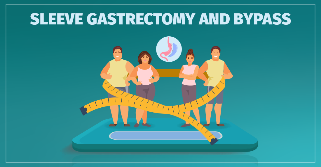 სლივგასტრექტომია და ბაიპასი